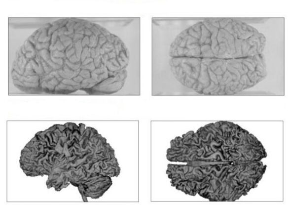 Ο εγκέφαλος ενός υγιούς ανθρώπου (παραπάνω) και ο εγκέφαλος ενός αλκοολικού με μη αναστρέψιμες συνέπειες (παρακάτω)